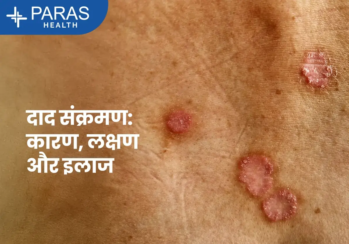 दाद (Ringworm) संक्रमण: कारण, लक्षण और इलाज