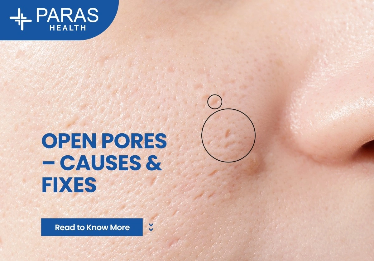 Open Pores on Face: Causes, Treatments, and Home Remedies