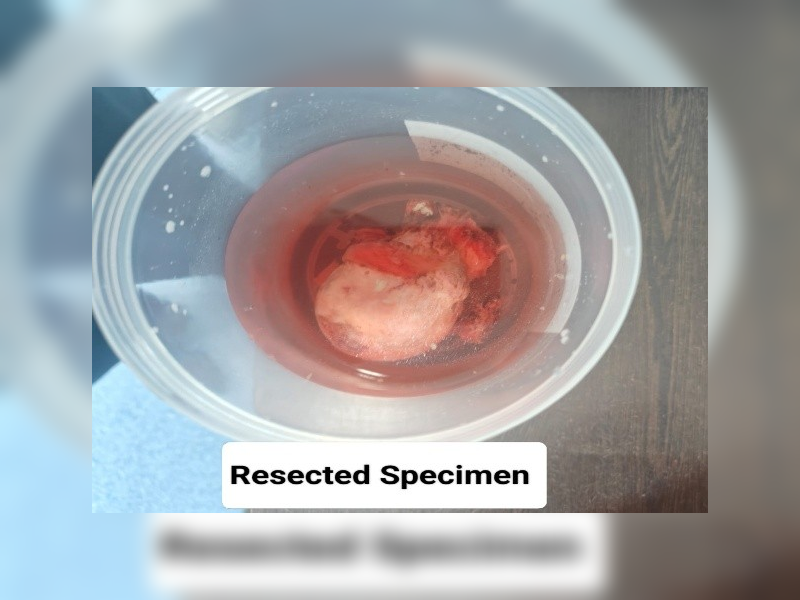Successful Treatment of a Rare Giant Cell Tumor of the Femoral Head with Limb-Sparing Hip Reconstruction (3)