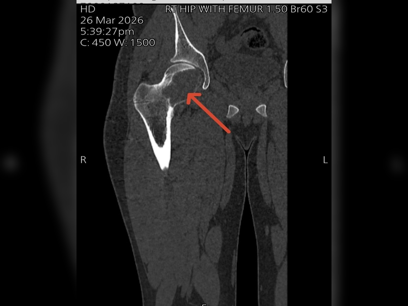 Successful Treatment of a Rare Giant Cell Tumor of the Femoral Head with Limb-Sparing Hip Reconstruction (4)