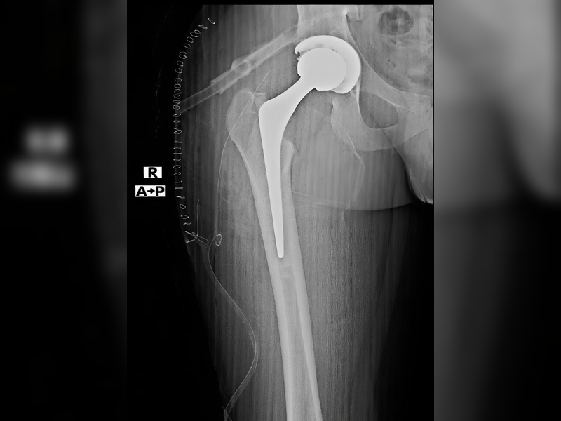 Successful Treatment of a Rare Giant Cell Tumor of the Femoral Head with Limb-Sparing Hip Reconstruction (2)