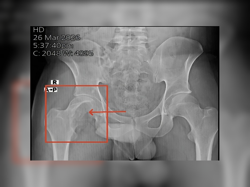 Successful Treatment of a Rare Giant Cell Tumor of the Femoral Head with Limb-Sparing Hip Reconstruction (1)