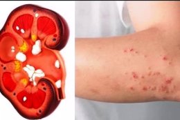 Effect of diabetes on the kidneys?
